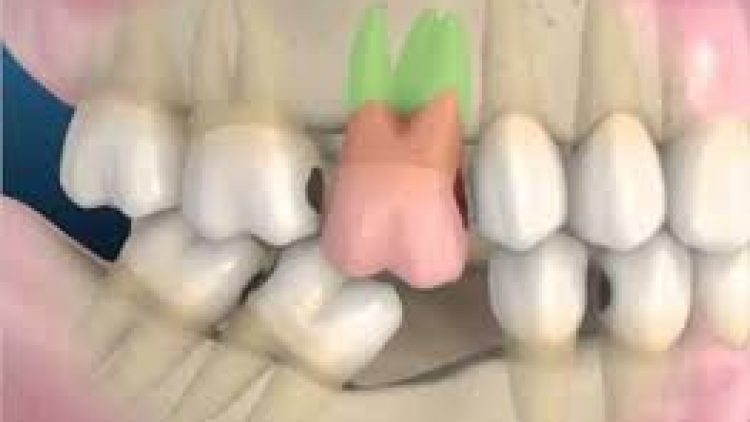 Perlunya memasang gigi palsu setelah cabut gigi